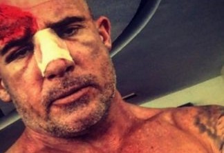 Dominic Purcell após acidente